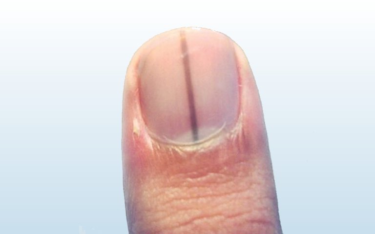 Dermatologista Dra. Fernanda Trindade | Manchas escuras nas unhas: Podem ser Câncer de Pele?